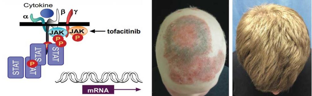 Un nuovo percorso per la cura dell’Alopecia Areata