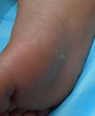 Attenzione alla desquamazione della pelle dei piedi